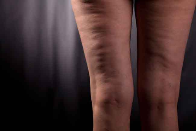 सेल्यूलाइट दूर करने वाले योग